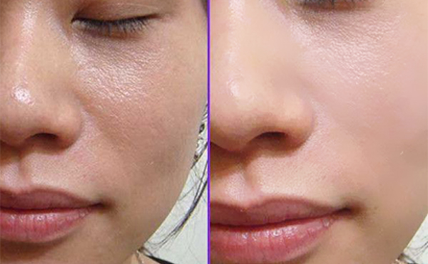 做e光嫩膚前要注意什么？