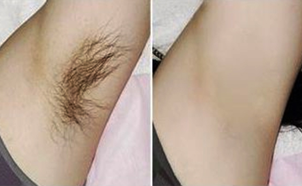光子脫腋毛有什么優(yōu)勢？