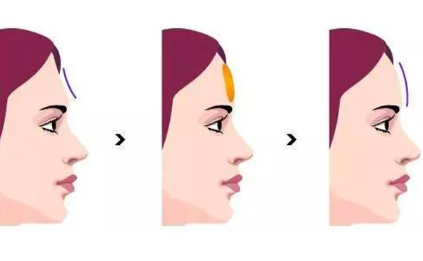 玻尿酸豐額頭怎么樣?適合哪些人?術前術后要注意什么?