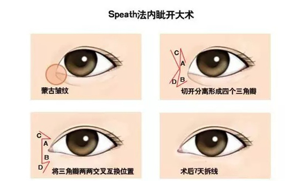 開內眼角復雜嗎?手術過程是什么?