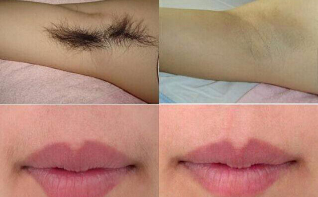 冰點脫毛大概多少錢？