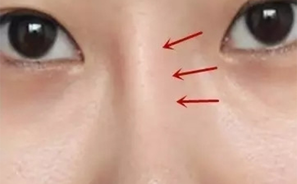 假體隆鼻時間長了出現(xiàn)假體移位等并發(fā)癥后該怎么辦？