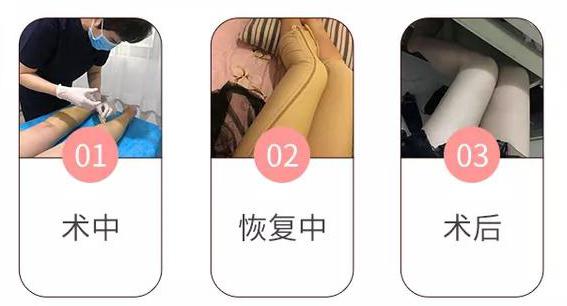 北京華韓：吸脂塑形術(shù)前術(shù)后效果對(duì)比圖