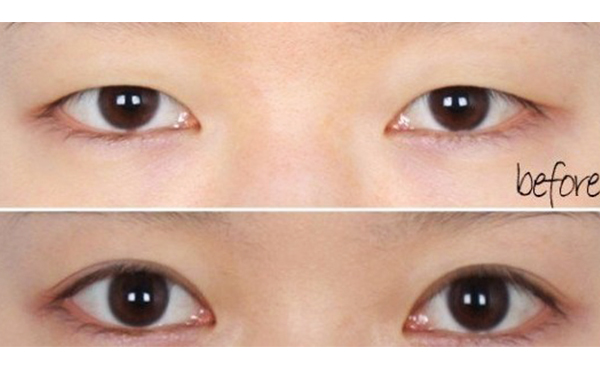 上瞼下垂一定要做嗎?上瞼下垂修復(fù)效果好嗎?