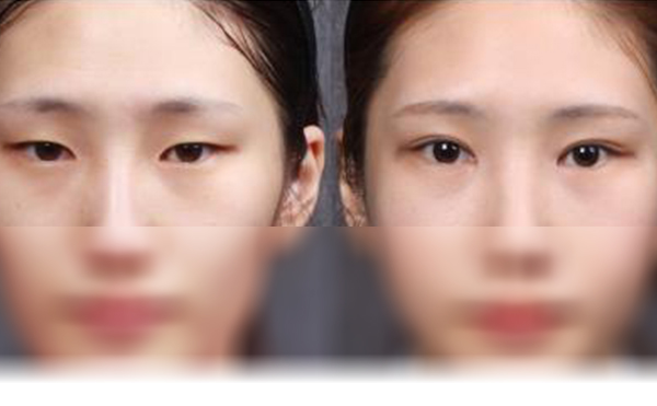 雙眼皮和開眼角可以一起做嗎?效果怎么樣?