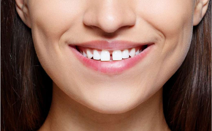 牙縫大可以矯正嗎？