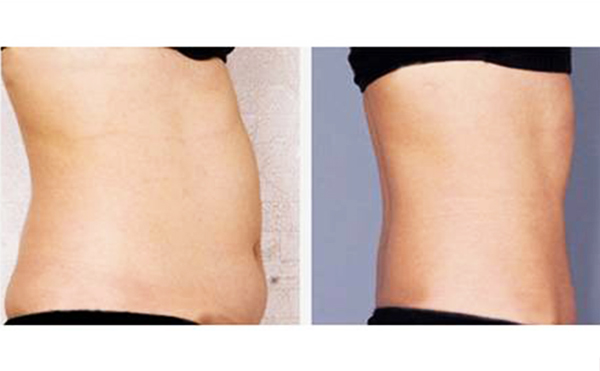 腰腹吸脂安全性高嗎？