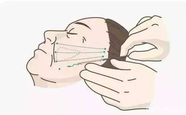 線雕提升好嗎？