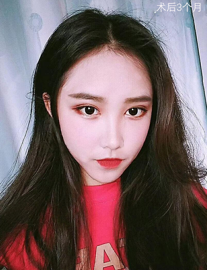 于世川醫(yī)生雙眼皮手術(shù)術(shù)后三個月效果