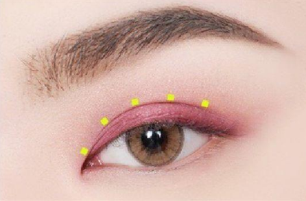 自體脂肪豐眼窩成活率高嗎？