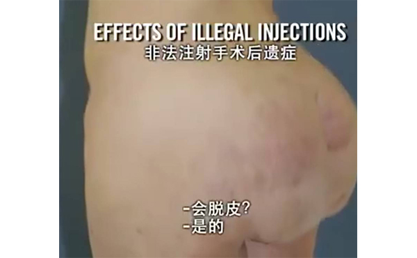 自體脂肪豐臀會留疤嗎?術(shù)后皮膚不平整怎么辦?