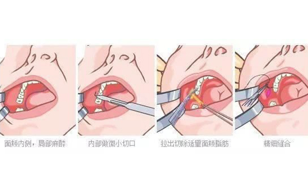 面部吸脂和取頰脂墊有什么區(qū)別?哪個(gè)效果好?