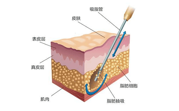 背部吸脂術(shù)后會留疤嗎?會不會反彈?