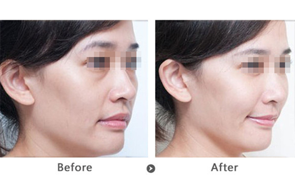 玻尿酸去法令紋多少錢？