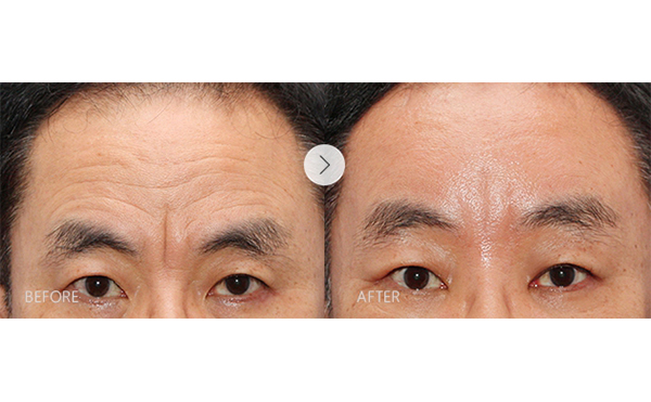 玻尿酸去抬頭紋安全嗎？