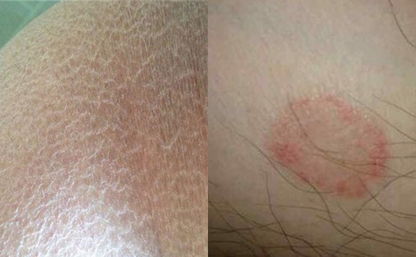 脫腋毛有什么副作用嗎？