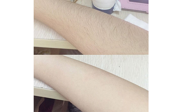 光子手臂脫毛效果怎么樣？