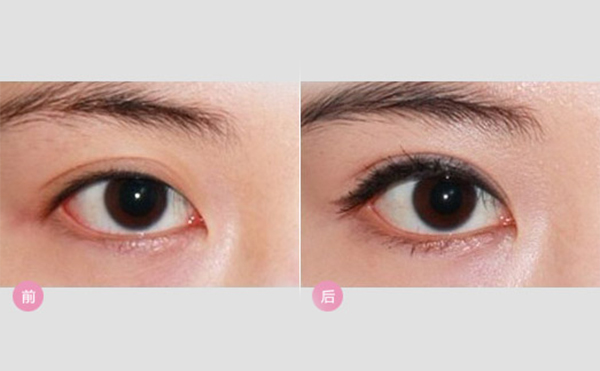 眼瞼外翻矯正方法有哪些?眼瞼外翻術(shù)后有什么常見問題?