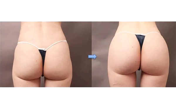 假體豐臀要注意什么?術(shù)后會(huì)不會(huì)移位?
