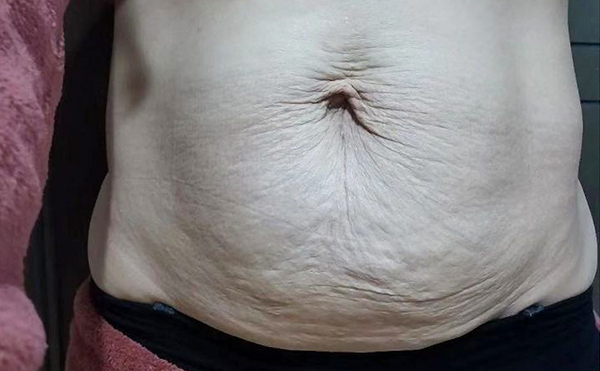 腹壁松弛有哪幾種類型?腹壁成形術(shù)哪些人不適合做?