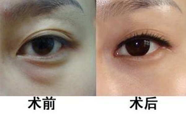 眼袋抽脂適合哪些人？