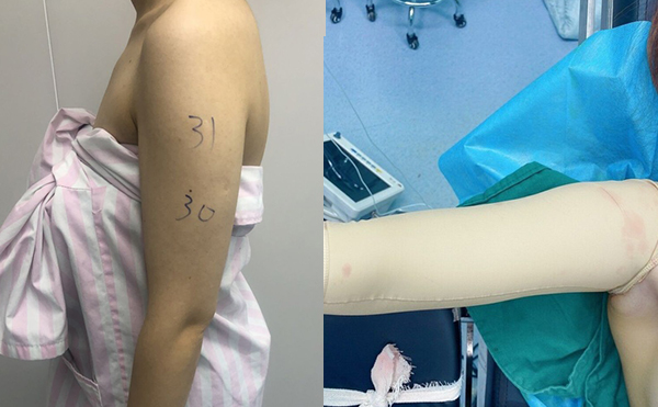 手臂吸脂安全嗎？