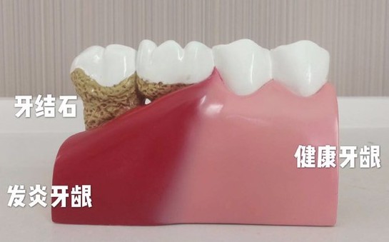 洗完牙后牙齒會變得敏感？