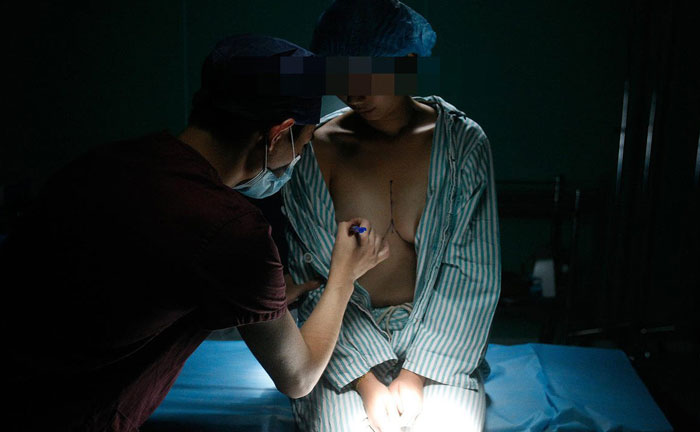 目前哪種隆胸最安全？假體隆胸哪種植入方法最好？