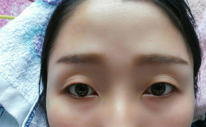 眼瞼凹陷怎么回事？眼瞼凹陷用什么填充最合適？