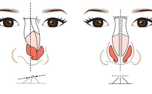 歪鼻矯正手術(shù)大概多少錢？歪鼻矯正手術(shù)成功率為多少？