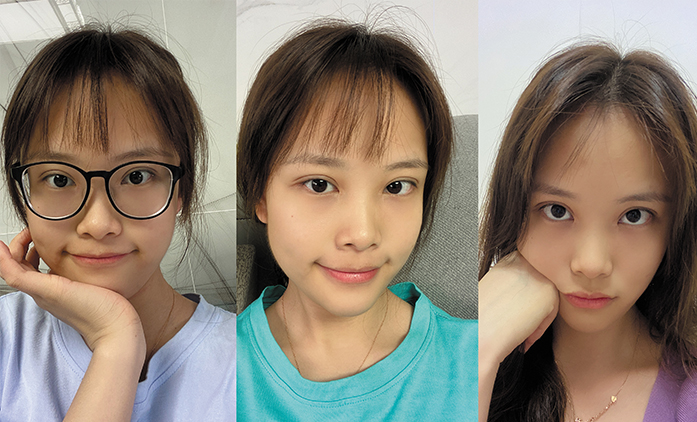 埋線提升案例效果對比圖2