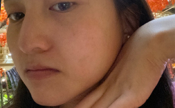 上海首爾麗格樸興植下頜角截骨手術(shù)案例術(shù)后兩個(gè)月