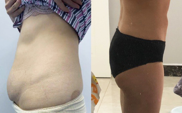 腹壁成形術(shù)多少錢?產(chǎn)后多久可以做腹壁成形術(shù)?