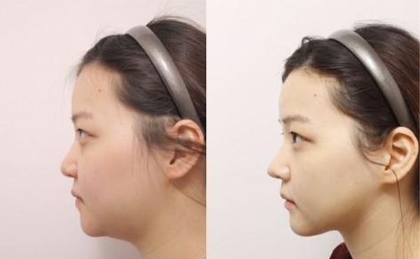 五類建議做下巴整形的下巴，快看看有沒有你