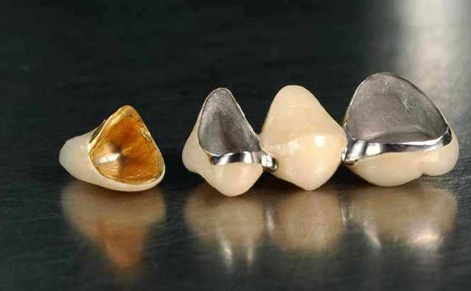 貴金屬烤瓷牙多少錢(qián)一顆？