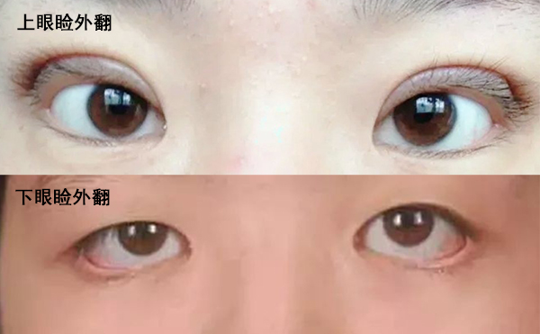 眼瞼外翻是什么導(dǎo)致的?眼瞼外翻怎么修復(fù)?