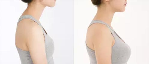 假體隆胸手術(shù)效果對(duì)比圖1