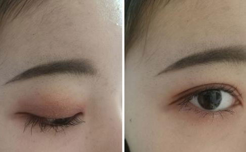 割雙眼皮的危害是什么？