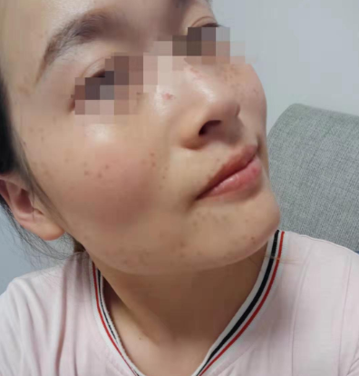 術(shù)后三天祛斑案例效果對(duì)比