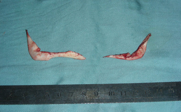 切除下頜角瘦臉方法安全嗎？手術(shù)的優(yōu)勢有哪些？