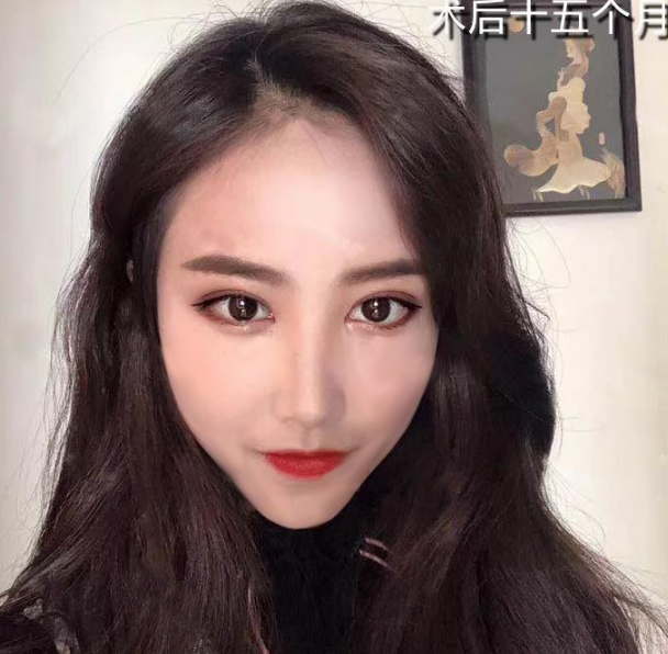 微創(chuàng)雙眼皮術(shù)后十五個月效果