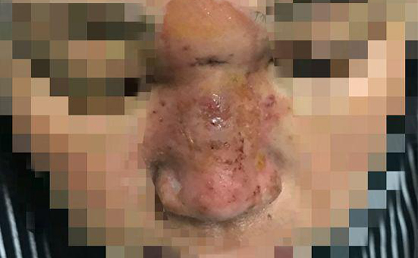 絕對(duì)不能用于注射隆鼻的材料