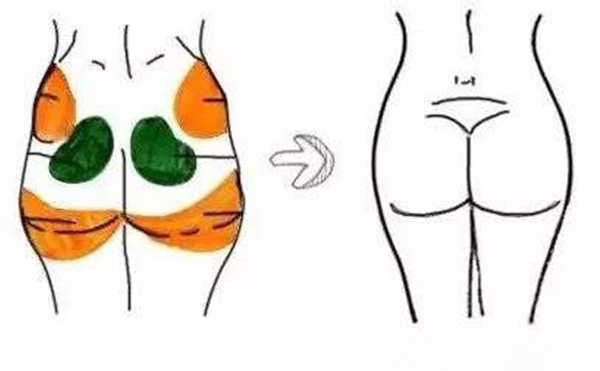 自體脂肪豐臀價(jià)格多少?會(huì)反彈嗎?