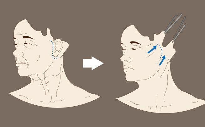 電波拉皮一次大概多少錢？