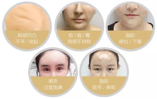 不同皮下脂肪堆積