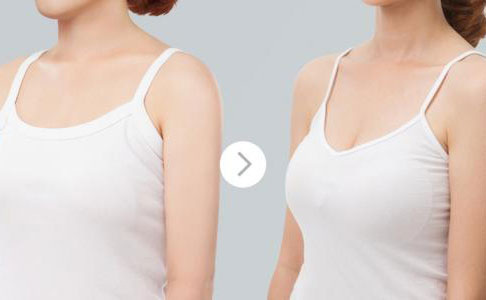 假體隆胸的費用是多少？