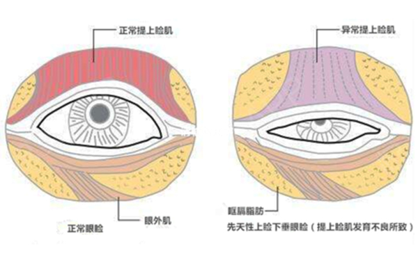 如何判斷真假性上瞼下垂?上瞼下垂做雙眼皮可以改變嗎?
