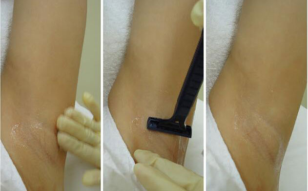 激光脫腋毛安全嗎？