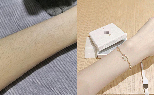 冰點(diǎn)手臂脫毛安全嗎