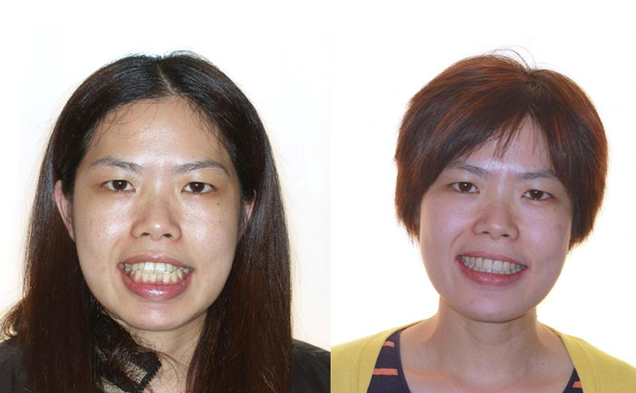 齙牙矯正可以改善凸嘴嗎？